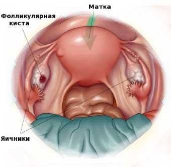 Фолликулярная киста что это такое