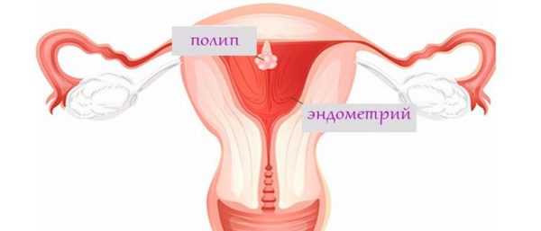 Фото полип эндометрия в матке