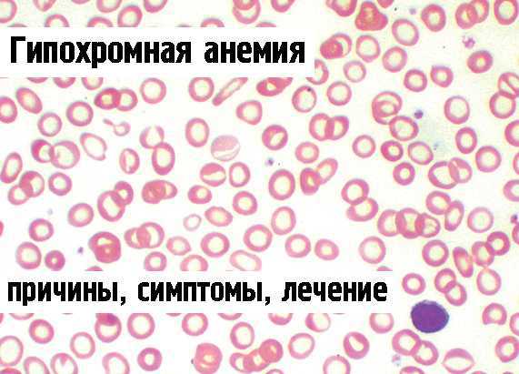 Гипохромия железодефицитная анемия. Гипохромная анемия. Гипохромная микроцитарная анемия. Гипохромная анемия микроцитарная анемия. Гипохромная анемия симптомы.