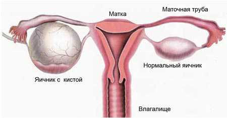 Из за чего киста яичника образуется