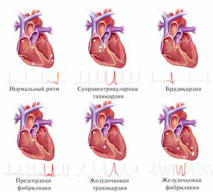 Кардиограмма сердца расшифровка