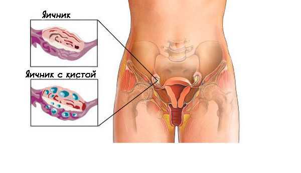 Киста эндометриоидная яичника