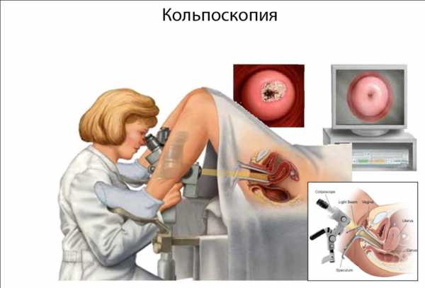 Кольпоскопия шейки матки что