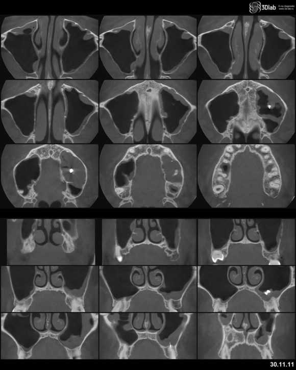 Сделать кт носа. Кт придаточных пазух носа в 1 проекции. Кт гайморовых пазух носа.