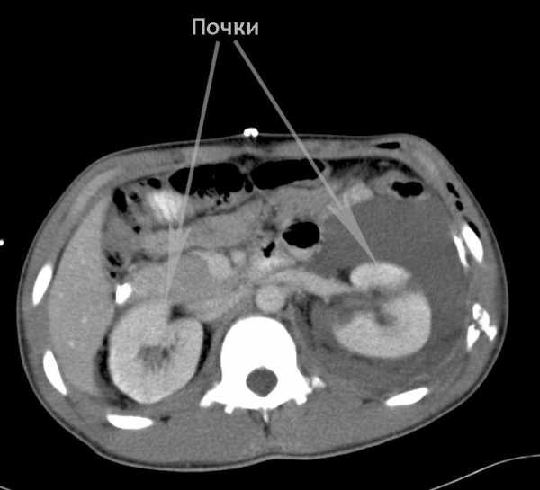 Кт почек с контрастом