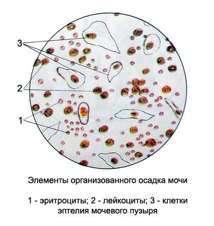 Лейкоциты микроскопия в моче повышены