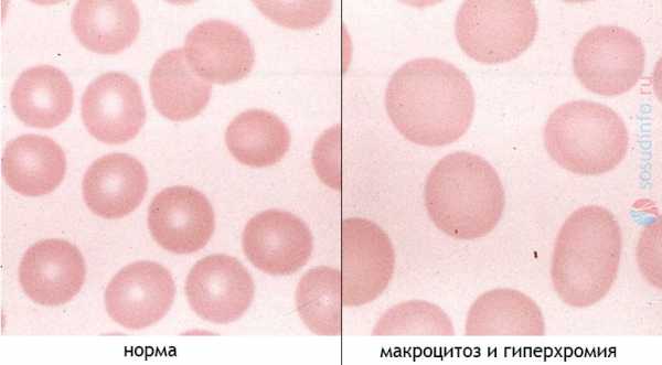 Макроцитоз в общем анализе крови