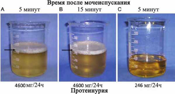 Моча пенится у женщин