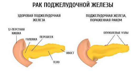 Обесцвеченный кал при гепатите фото