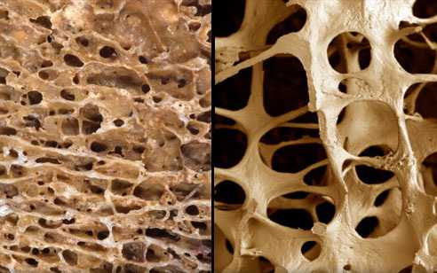 Обследование костей на остеопороз денситометрия