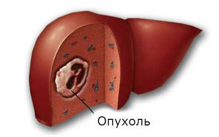 Очаговое образование печени что это