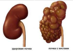 Паренхиматозные кисты почек что это такое