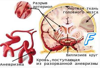 Первая помощь геморрагический инсульт