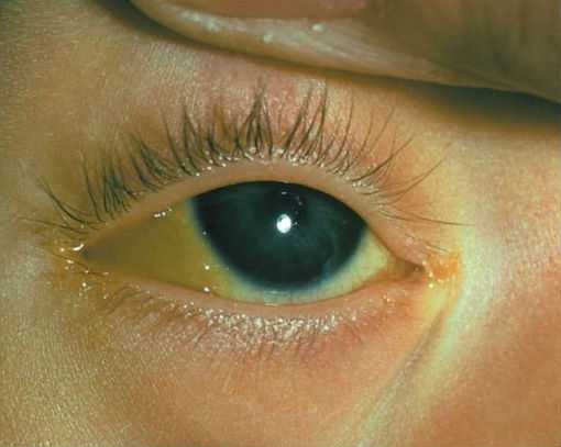 Почему глаза желтоватого. Иктеричность склер у новорожденных.