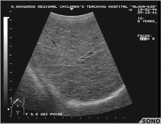 Поджелудочная железа неоднородная повышенной эхогенности. Желчный пузырь повышенной эхогенности. Высокая эхогенность печени. Повышение эхогенности паренхимы печени. Пониженная эхогенность печени.