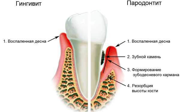 Привкус железа во рту при кашле