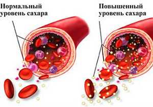 Признаки повышенного сахара в крови у женщины