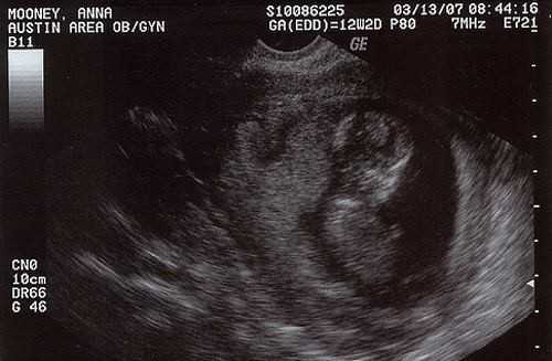 Беременность 12 3. УЗИ 12 недель беременности. Эмбрион на 12 неделе беременности УЗИ. УЗИ 12 недель беременности фото. Как выглядит плод на 12 неделе беременности на УЗИ.