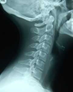 Рентген шеи с функциональными пробами