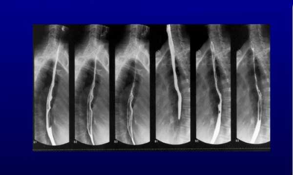 Рентгеноскопия желудка и пищевода