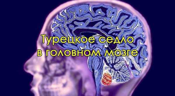 Формирующееся турецкое седло в головном мозге. Турецкое седло. Турецкое седло мозг. Турецкое седло головного мозга человека. Синдром турецкого седла в головном мозге что это такое.