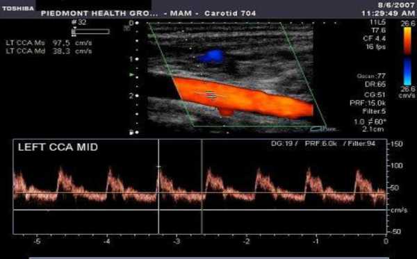 Ультразвуковая допплерография брахиоцефальных артерий