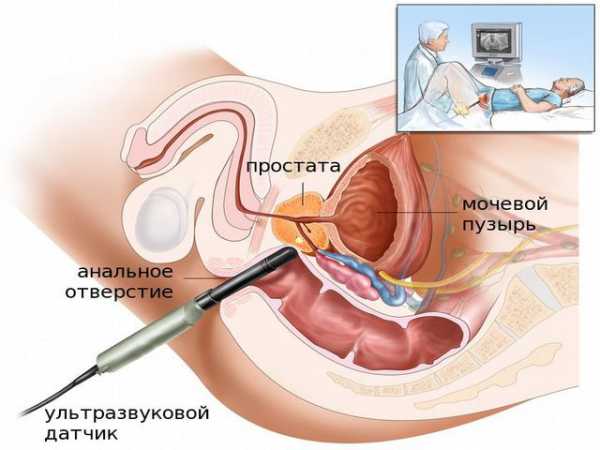 Узи предстательной железы трансректальное