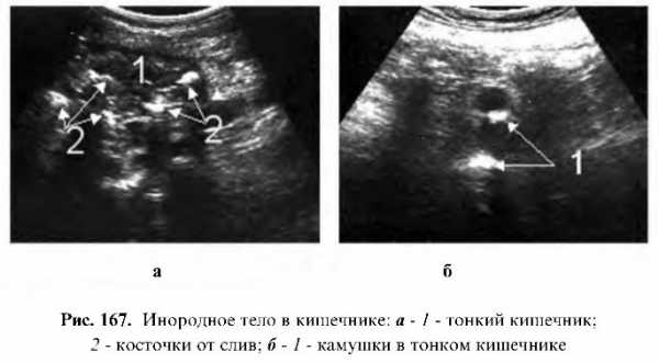 Узи покажет инородное тело