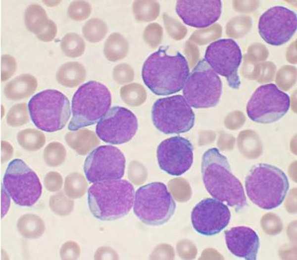 В анализе крови активированные лимфоциты