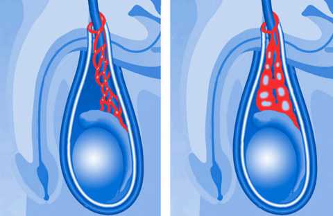 Варикоцеле может ли пройти само