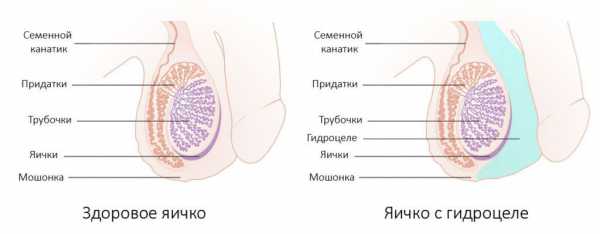 Водянка яичек у мальчиков в 3 года